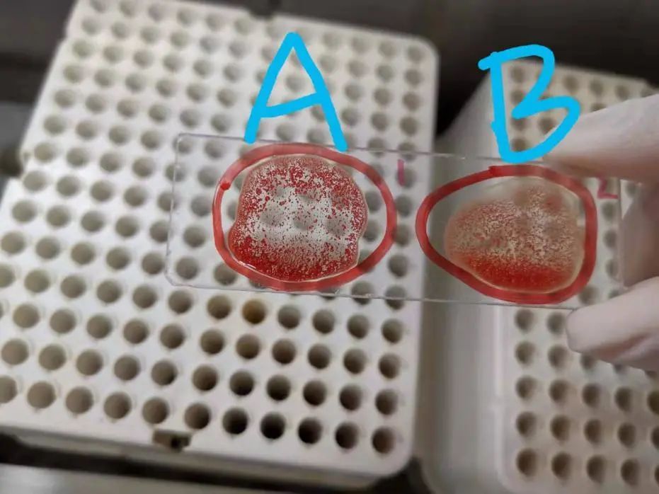 【灵魂拷问】工作中所有的冷凝集都被我们筛出来了吗?_腾讯新闻