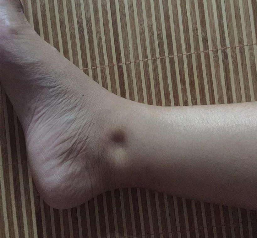 肾出现问题引发水肿,主要因为肾脏担负着人体的代谢作用,一旦出现不适