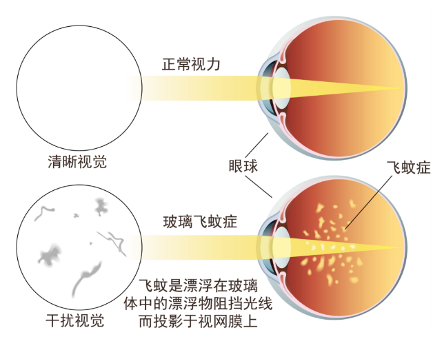 性飛蚊症|生理性飛蚊症|視網膜脫離|玻璃體後脫離|葡萄膜炎|高度近視