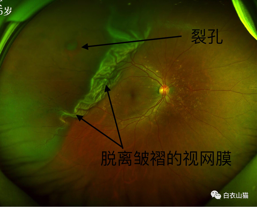 注意,眼前突然出现的黑影或闪光,也许因为你的视网膜破了个洞!