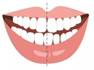 牙齿中线不齐怎么办脸歪可以通过矫正改善吗