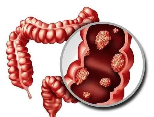 做完肠镜,我们首先会看到肠镜报告的描述,其中盲肠,升结肠,横结肠,降