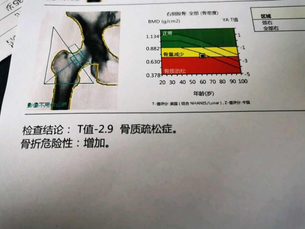 65歲阿姨一次彎腰三根肋骨骨折為啥出現這種情況醫生講清真相