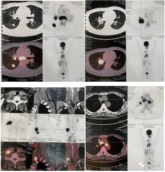 2020 年 9 月外院 pet/ct:右下肺背段 16*10 mm 佔位,suvmax=27.