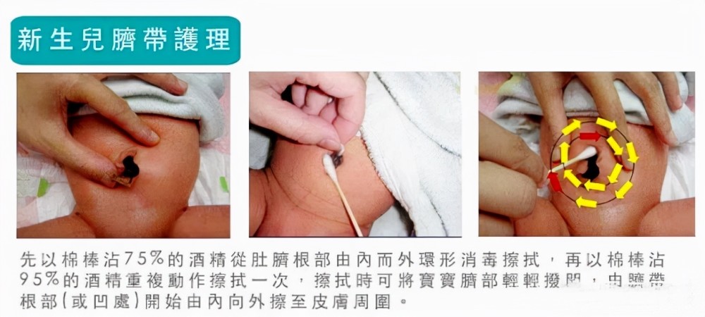 消毒方法:一手轻轻地抬起脐带的打结处,另一手拿着沾有75%酒精的棉签