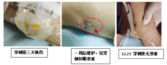 上臂港输液港渗液到底发生了什么