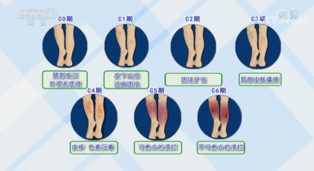 这就是静脉曲张的表现