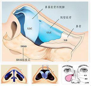 鼻中隔偏曲手术矫正方法了解一下