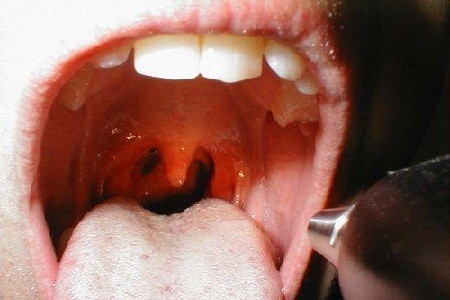 预防扁桃体发炎要注意哪些