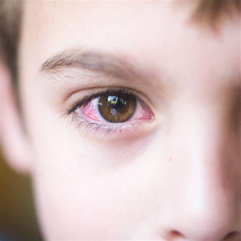 为什么有的人眼睛红得像兔子眼一样太吓人