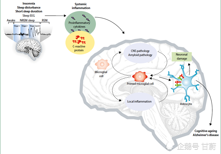 假设模型示意图:将睡眠障碍,炎症和阿尔茨海默病痴呆风险联系起来.