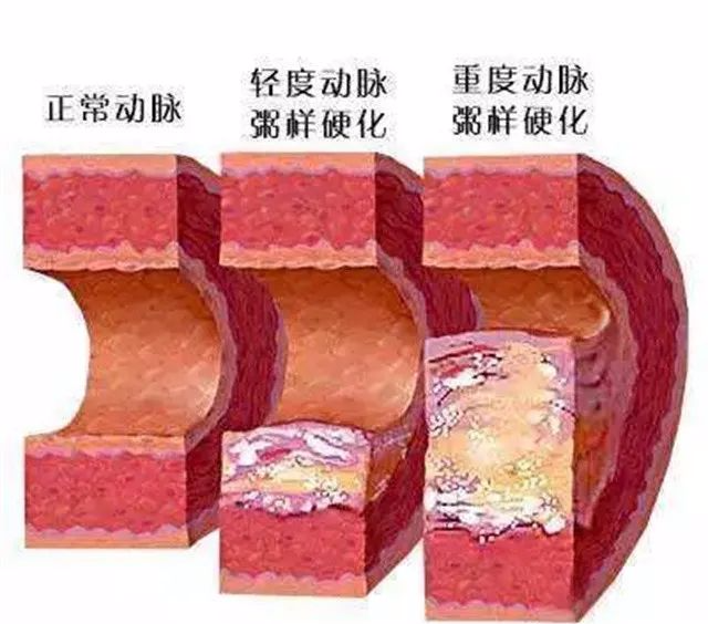 動脈粥樣硬化斑塊很危險,怎樣解決或者逆轉,心血管醫生告訴你