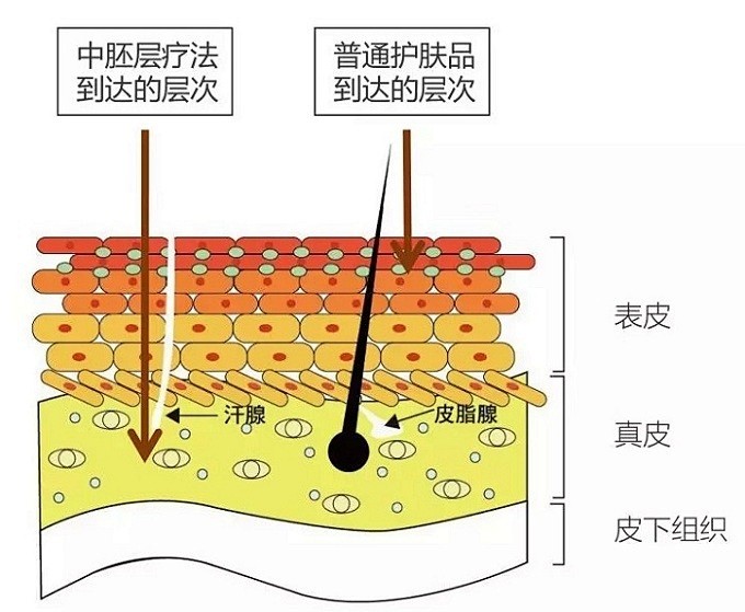 事实上,水光针的补水效果是因为它的"玻尿酸"成分,所以