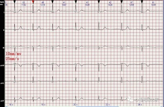 心電圖圖例分析31:二度Ⅰ型房室傳導阻滯,交界性逸搏心律