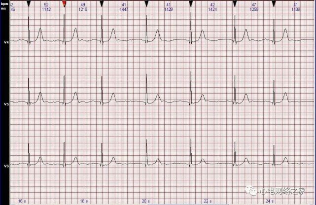 心电图图例分析31:二度Ⅰ型房室传导阻滞,交界性逸搏心律