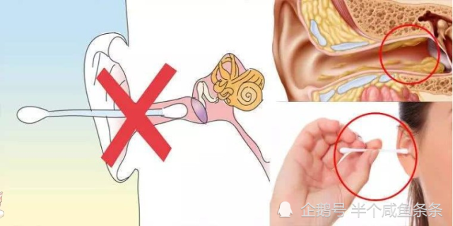 用棉籤掏耳朵竟會致癌不要隨便用棉籤掏耳朵否則