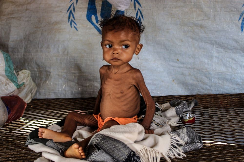 早安世界也门面临严重饥荒孩童骨瘦如柴令人心碎