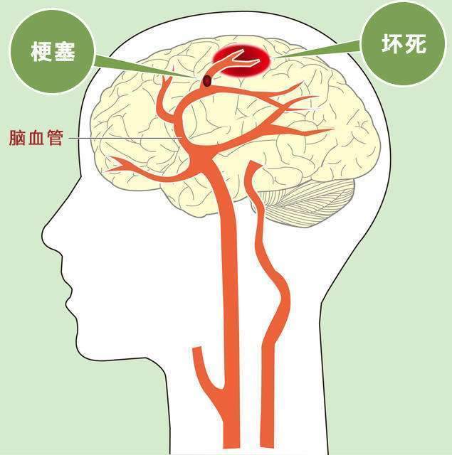 每年約有200萬人死於腦梗腦梗死的原因有哪些呢