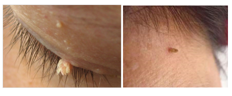 眼皮上长了一小搓金针菇而且会传染