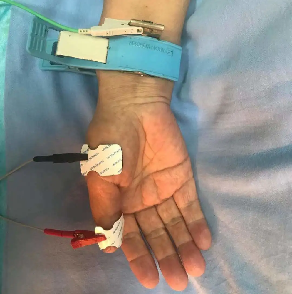 什么是肌电图肌电图检查怎么做专家为您揭秘