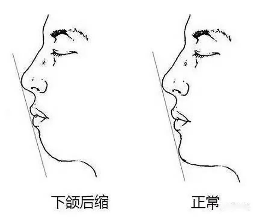 发现即矫正12岁前必须处理的20种儿童牙颌畸形