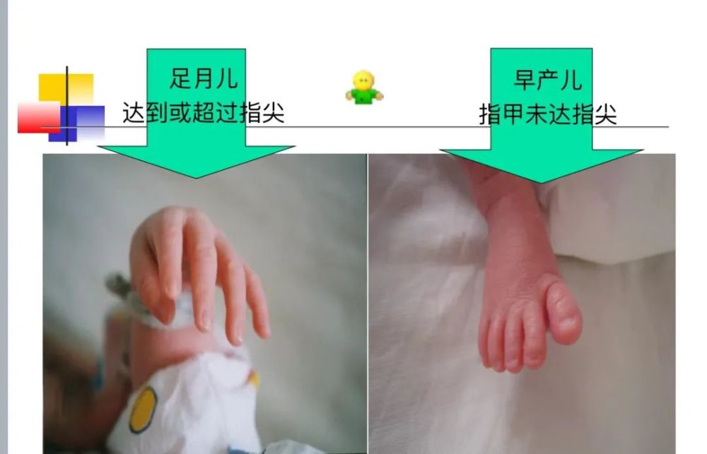 足月儿是指出生时,胎龄满37周和小于42周(260-293天);早产儿是指出生