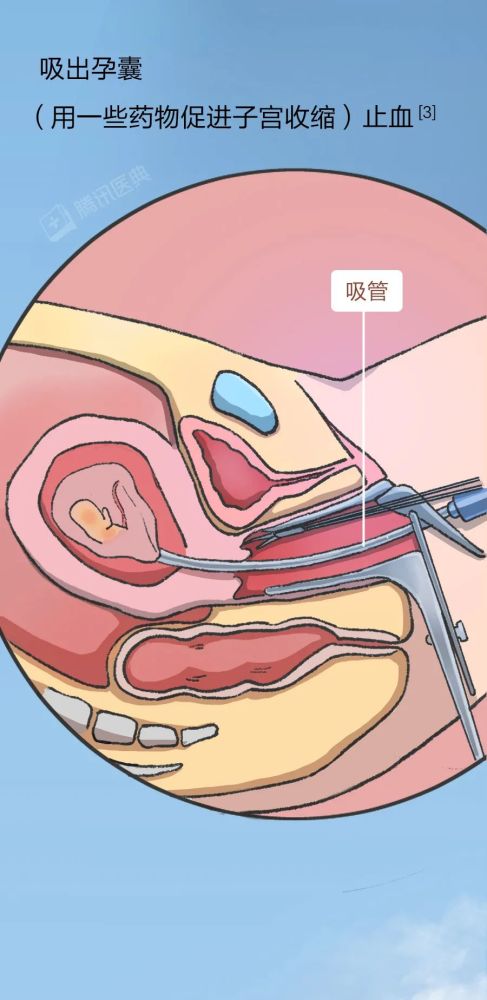 人流手术对女生来说有多残忍她的经历会告诉你答案