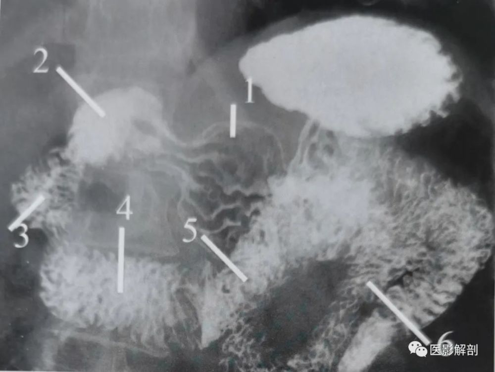 瀑布型胃:;c. 牛角型胃;d. 无力型胃.胃的分型a.