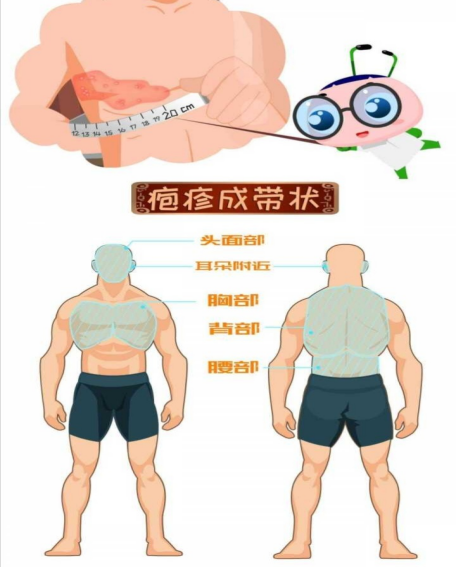 带状疱疹可发于腰部,也可发生在其他部位.