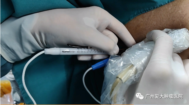 纳米刀被人民日报报道位于第二肝门的肿瘤无法热消融纳米刀提供新选择