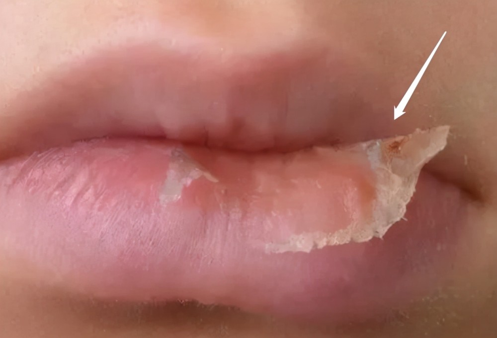 孩子嘴唇裂口又出血,还忍不住撕嘴皮,大夫的处理方式有些意外_腾讯