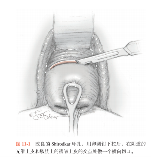 宫颈环扎术图解图片