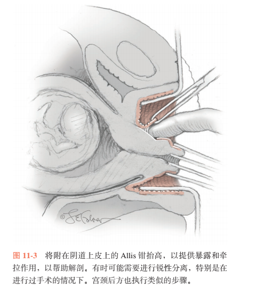 宫颈环扎术动画演示图片