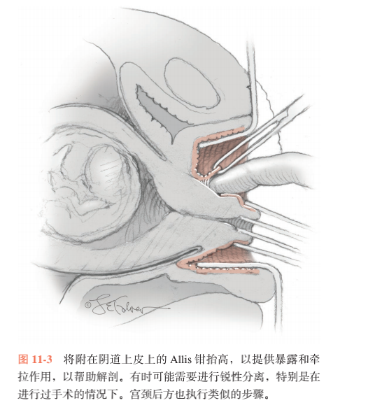 宫颈环扎术痛苦吗图片