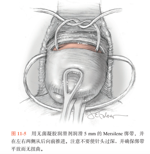妇产基本功宫颈环扎怎么做手术技巧你知道吗看这篇就对了