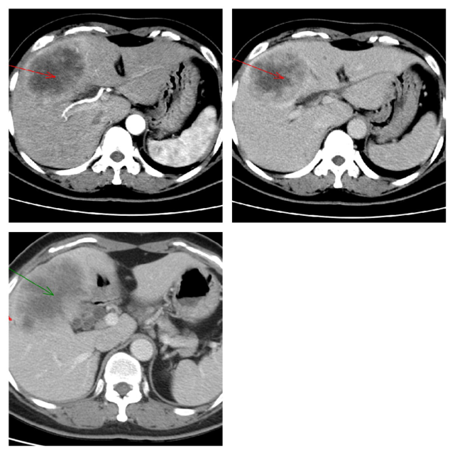 2 肝內膽管細胞癌平掃呈低密度灶,動脈期快速強化,靜脈期造影劑快速