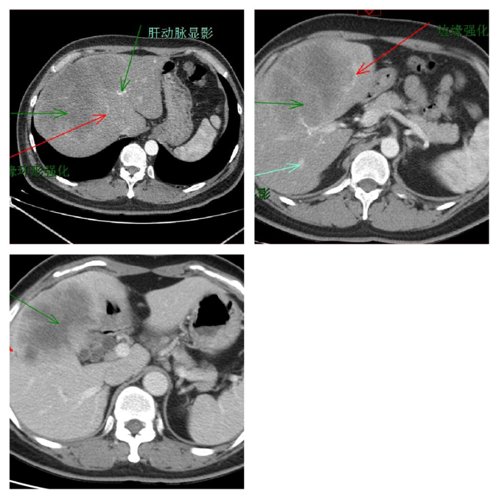 肝癌胰腺癌转移瘤一文理清肝胆胰常见疾病的ct鉴别诊断