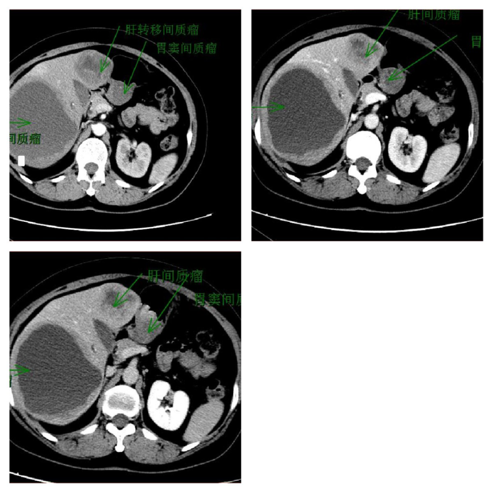 肝癌胰腺癌轉移瘤一文理清肝膽胰常見疾病的ct鑑別診斷