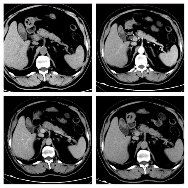 肝癌,胰腺癌,轉移瘤……一文理清肝膽胰常見疾病的 ct 鑑別診斷