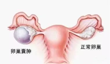不少女士经历过这样的事情:体检时超声检查发现,卵巢或附件区有囊肿