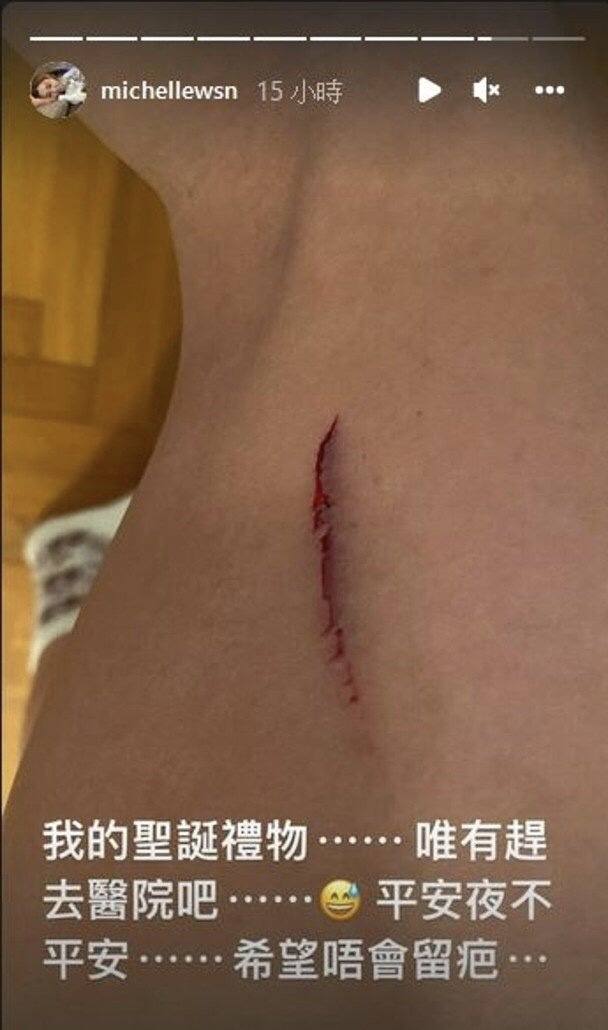 担心英皇女星自曝平安夜受伤大腿惊现血痕入院缝四针