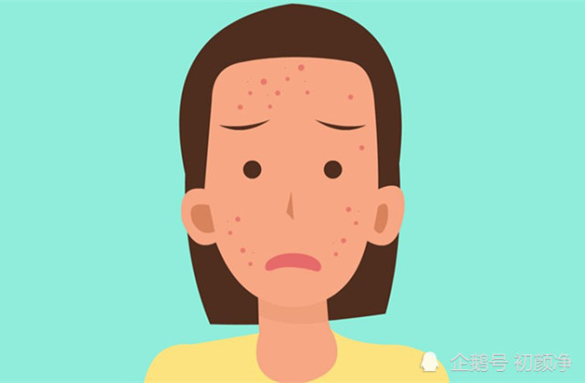 痘痘肌护理指南30岁该抗初老而不是抗痘