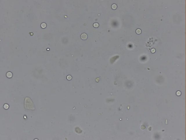 10x10(红,白细胞,脂肪球对比图)10x10某日值班,审核大便报告时发现