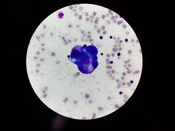 看抗酸涂片中发现的肿瘤细胞