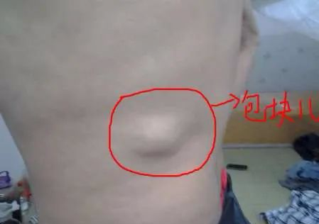 身上长出这样的"包块儿",可能是恶性肿瘤的预警!