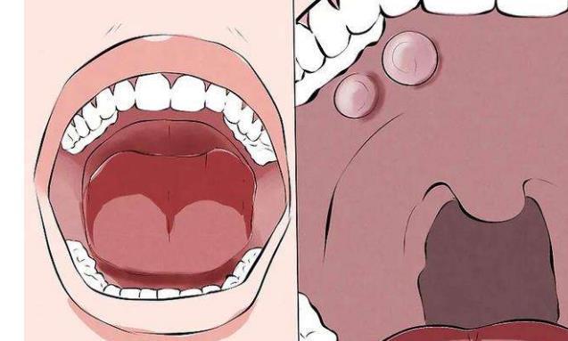 口腔溃疡|癌症|淋巴结肿大|口腔|口腔癌|口腔黏膜