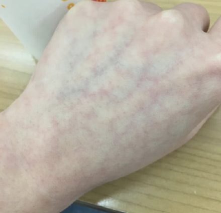 冬季困扰解决办法请收好|网状青斑|特发|冬季