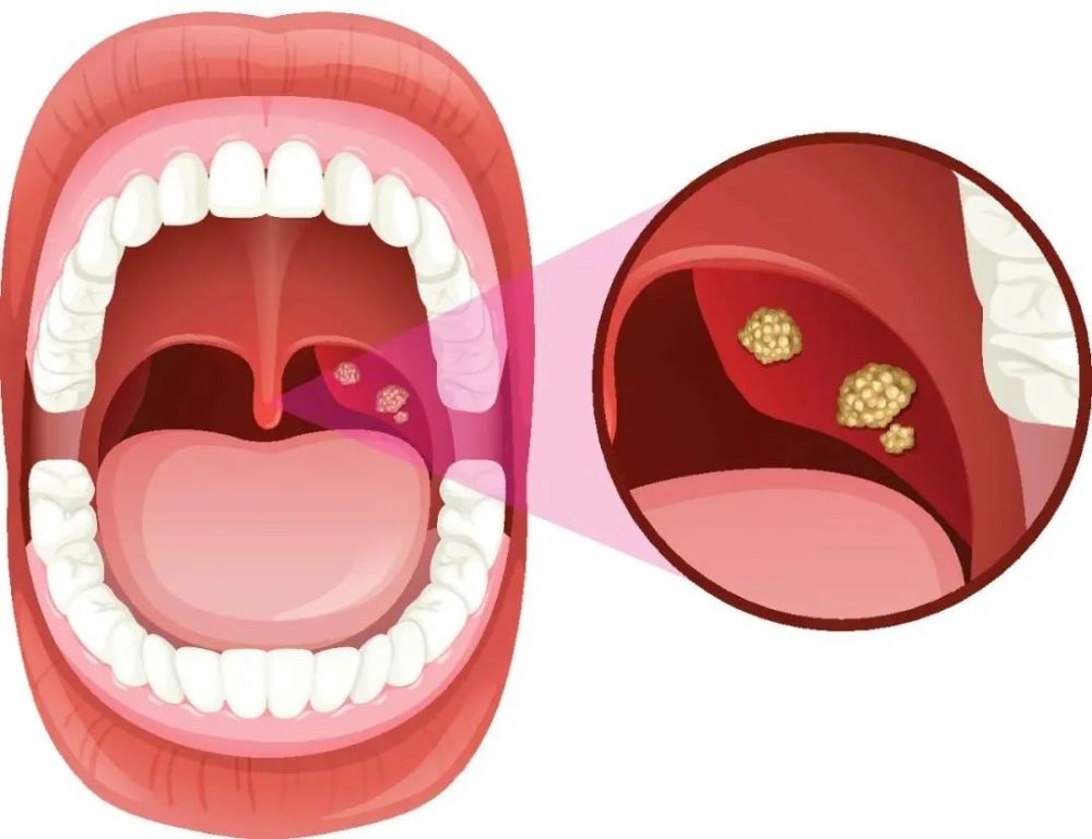 你的扁桃體為何發炎很積極