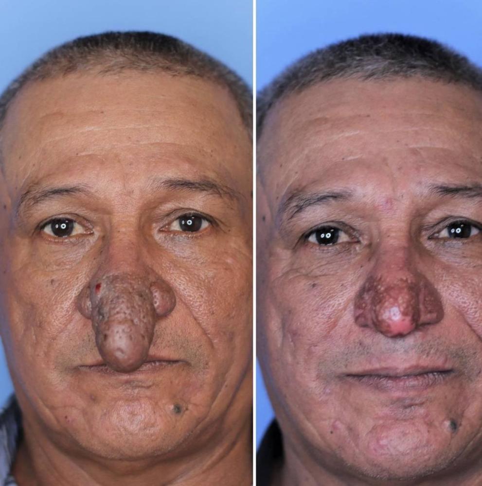 美国油漆工患怪病鼻子巨大偶然遇见恩人医生顺利手术得以解脱