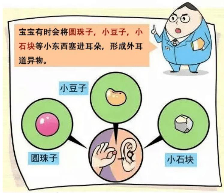 孩子耳内塞入一塑料玩具珠子家长越掏越深